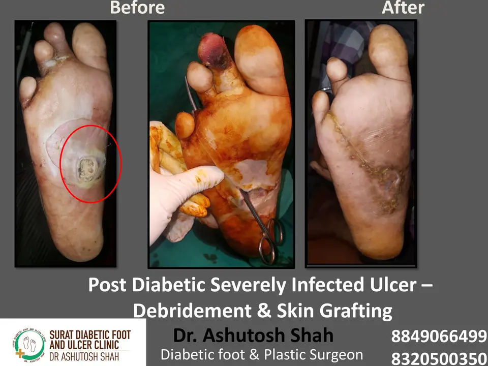 Diabetic Infection with Plastic Surgery Reconstruction.pptx-8.webp